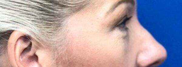 Upper Lid Blepharoplasty Before & After Image