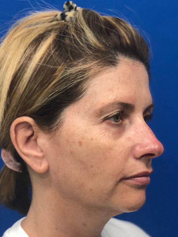 Facial Fillers Before & After Image