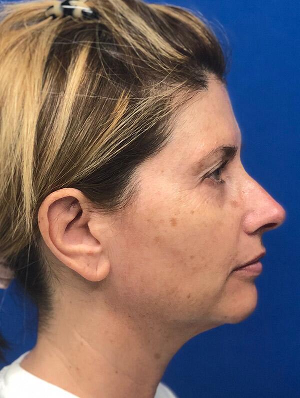 Facial Fillers Before & After Image