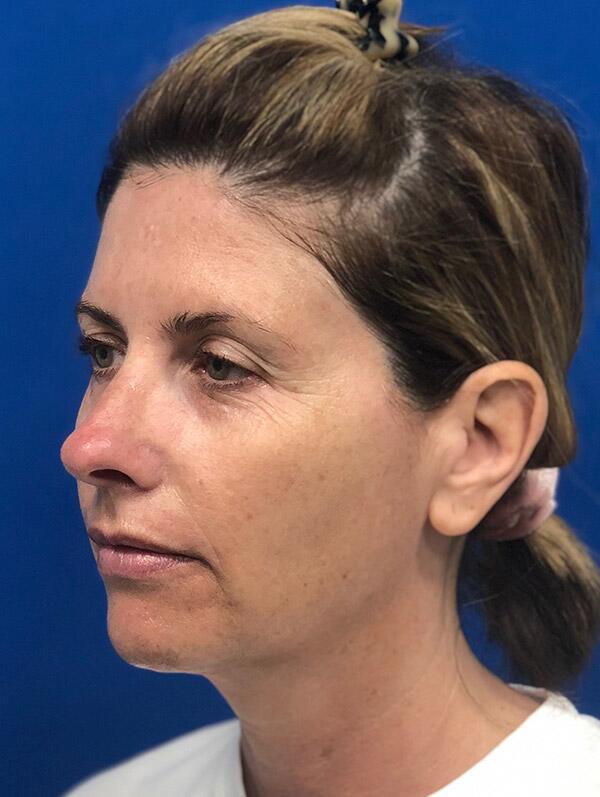 Facial Fillers Before & After Image