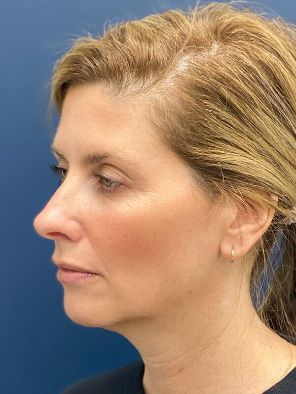 Facial Fillers Before & After Image