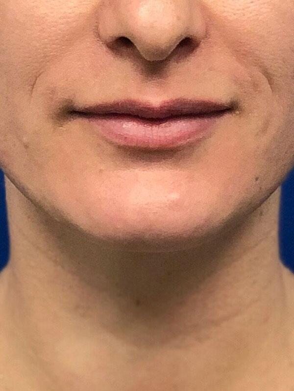 Lip Fillers Before & After Image