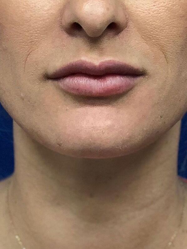 Lip Fillers Before & After Image