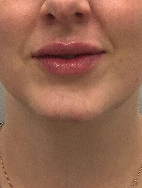 Lip Fillers Before & After Image