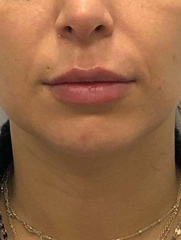 Lip Fillers Before & After Image