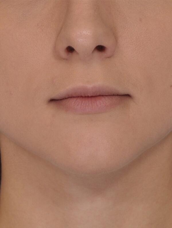 Lip Fillers Before & After Image