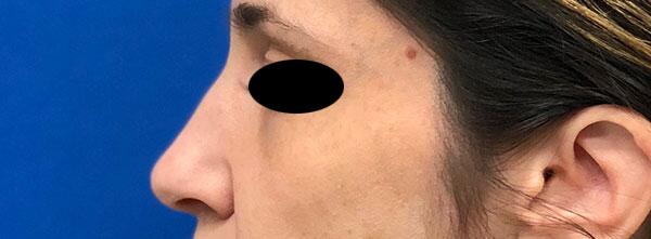 Liquid Rhinoplasty Before & After Image