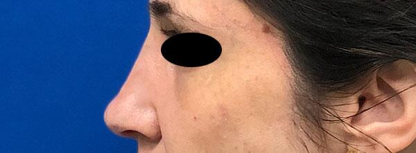 Liquid Rhinoplasty Before & After Image