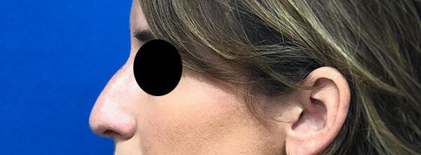 Liquid Rhinoplasty Before & After Image